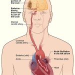 Καρδιακό-εγκεφαλικό επεισόδιο: πώς να τα αντιμετωπίσετε